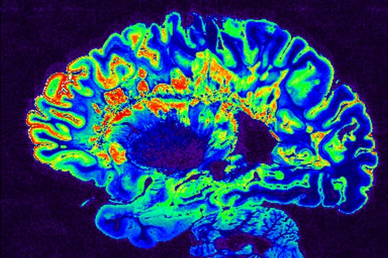 Il cervello colpito da sclerosi multipla (fonte: G. Bhagavatheeshwaran, D. Reich, NINDS-NIH) - RIPRODUZIONE RISERVATA