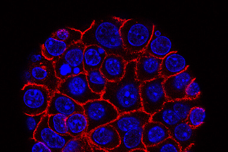 Cellule del tumore del pancreas (fonte: Min Yu/Eli and Edythe Broad Center for Regenerative Medicine and Stem Cell Research at USC,USC Norris Comprehensive Cancer Center, Pancreatic Desmoplasia, da Flickr) - RIPRODUZIONE RISERVATA