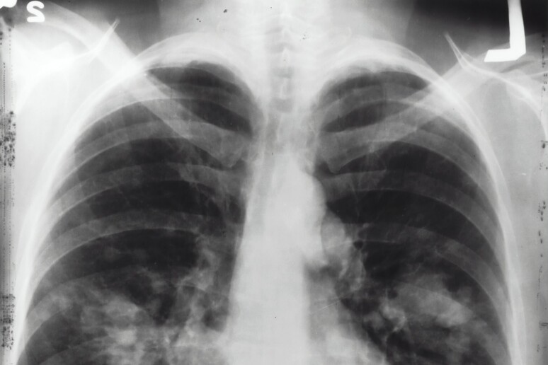 Tumore del polmone, paura e stigma frenano lo screening (free via unsplash) - RIPRODUZIONE RISERVATA