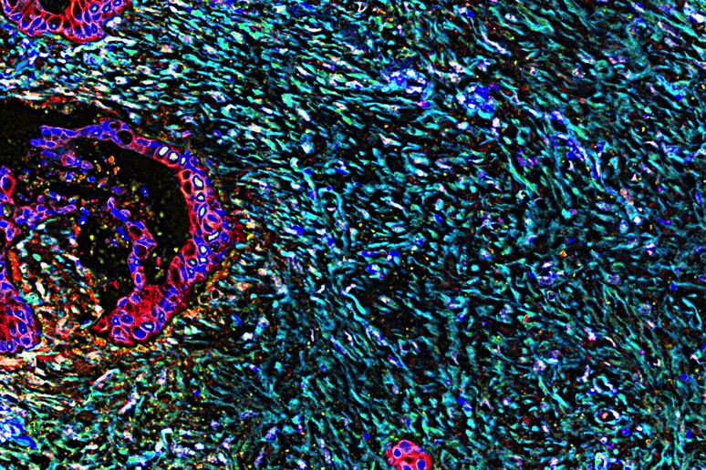 Tessuto del pancreas colpito dal tumore (fonte: Neelima Shah e Edna Cukierman, Fox Chase Cancer Center, National Cancer Institute, National Institutes of Health, da Flickr) -     RIPRODUZIONE RISERVATA