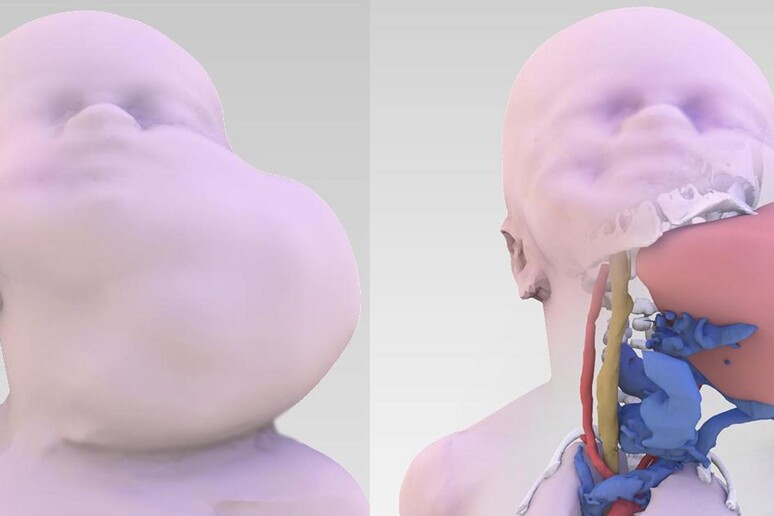 Ricostruzione 3D della massa tumorale del piccolo paziente nato con procedura EXIT-to-ECMO -     RIPRODUZIONE RISERVATA